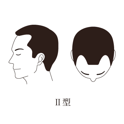 2型