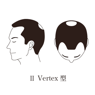 2V型