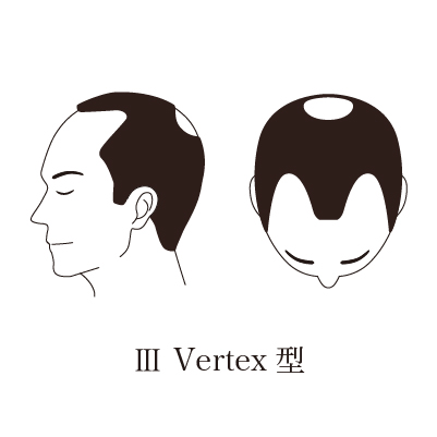 3V型