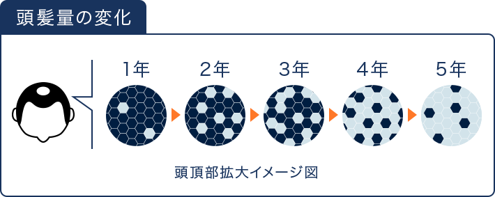 頭髪量の変化