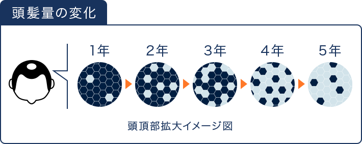 頭髪量の変化