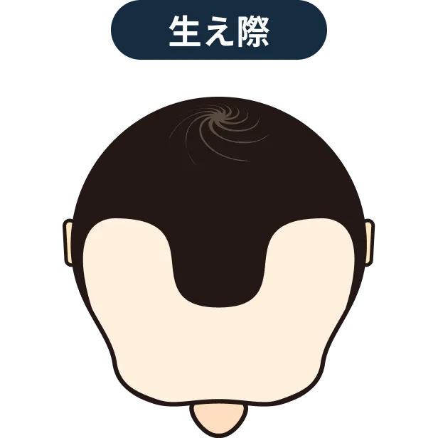 生え際