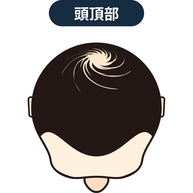 頭頂部