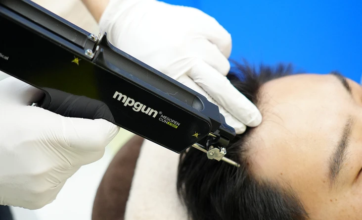 発毛結果AIシミュレーション