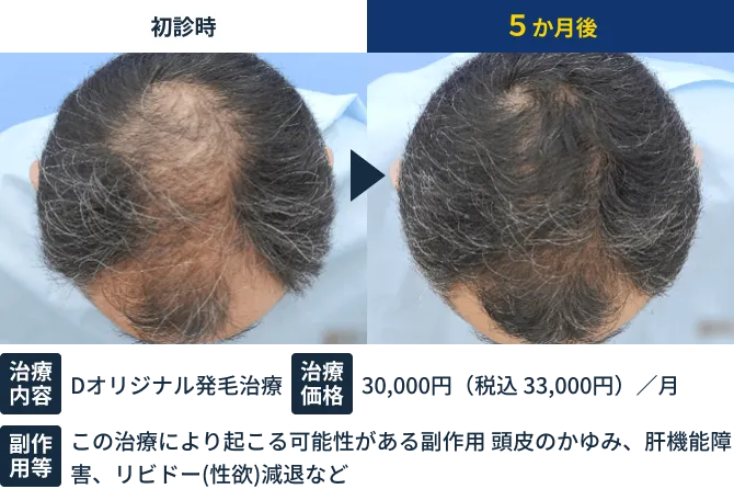 パーソナル発毛治療