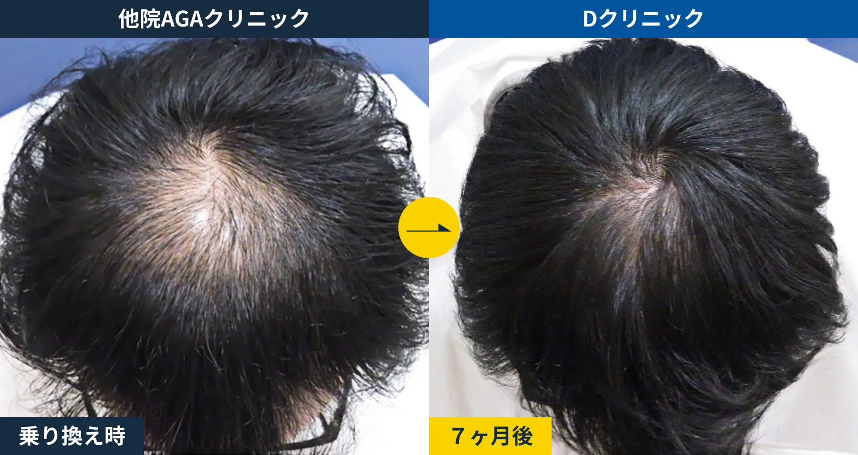 他院AGA治療からの乗り換え(30代)