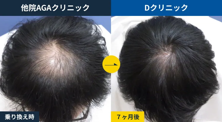 他院AGA治療からの乗り換え(30代)