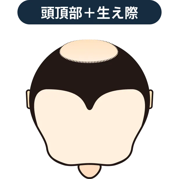 頭頂部＋生え際