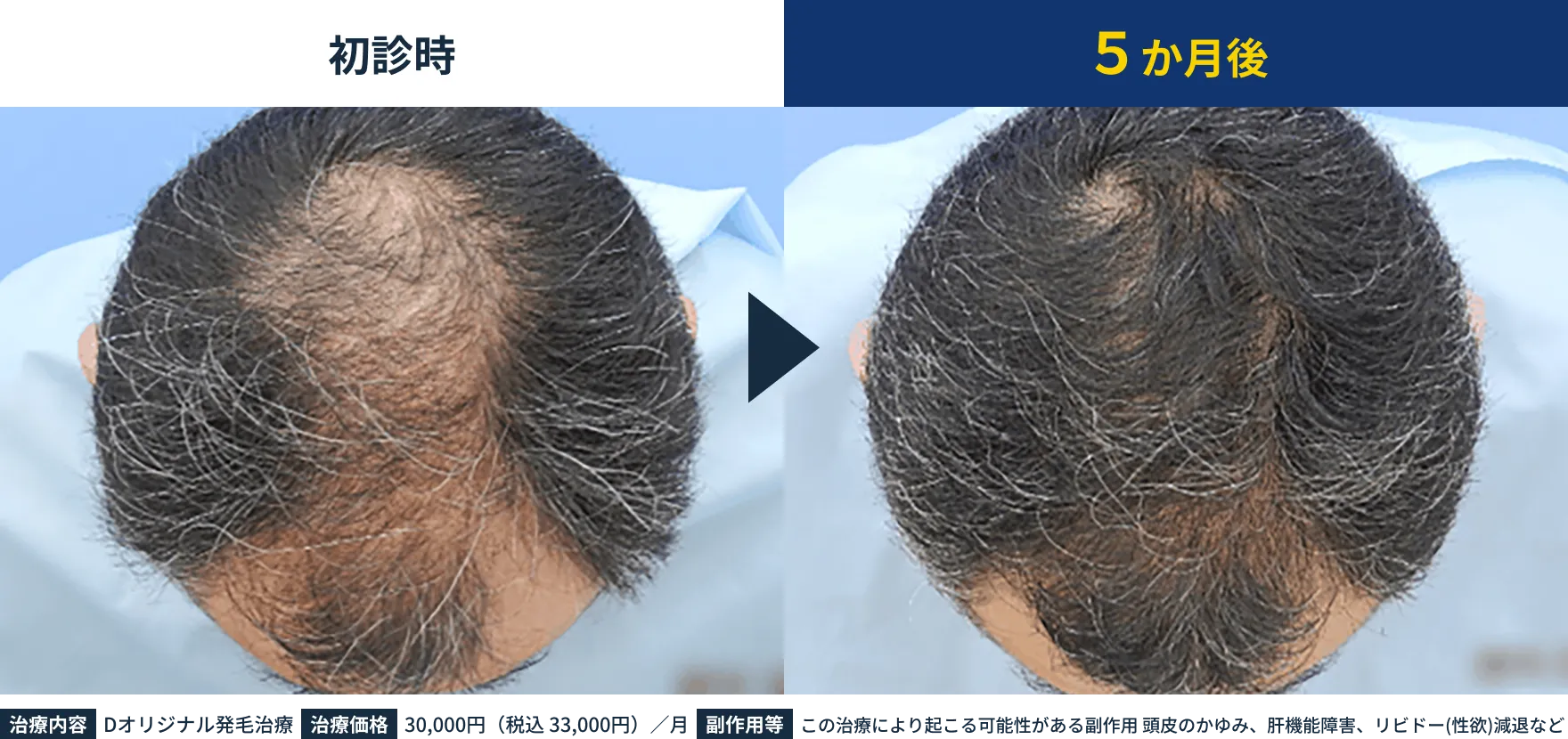 パーソナル発毛治療