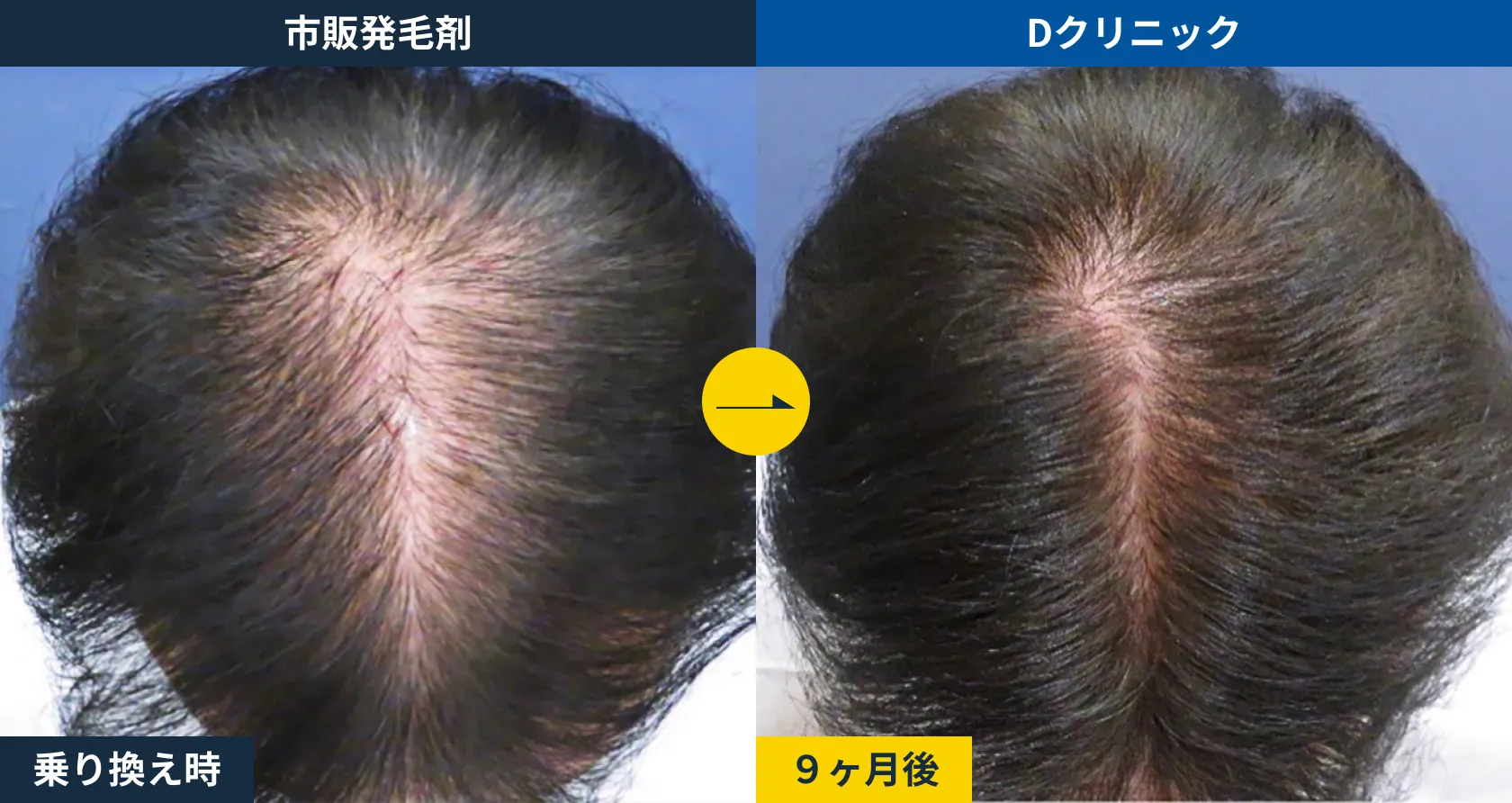 市販発毛剤からの乗り換え(50代)