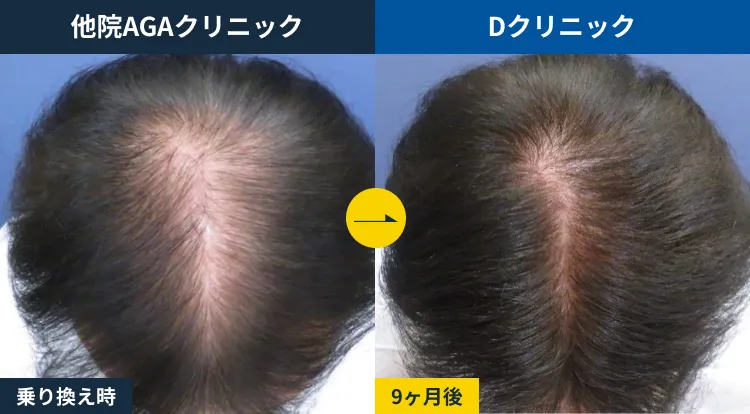 市販発毛剤からの乗り換え(50代)