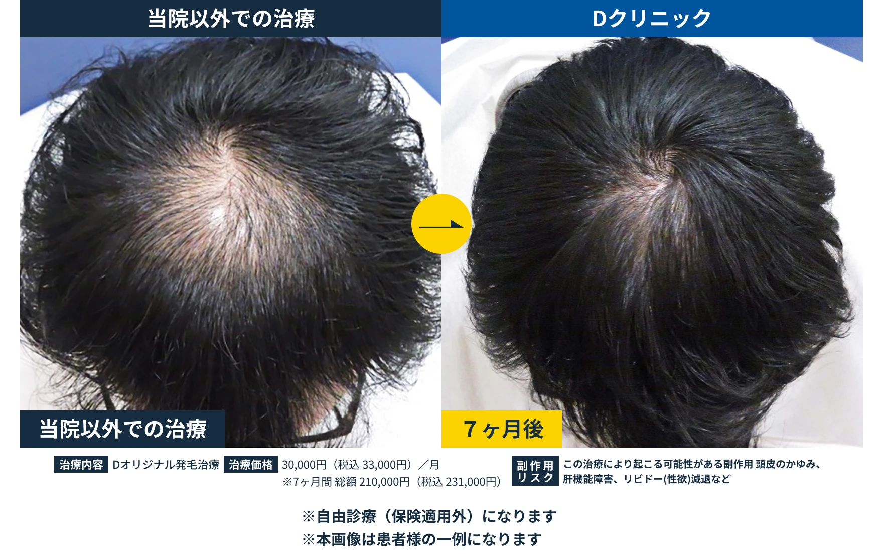 パーソナル発毛治療