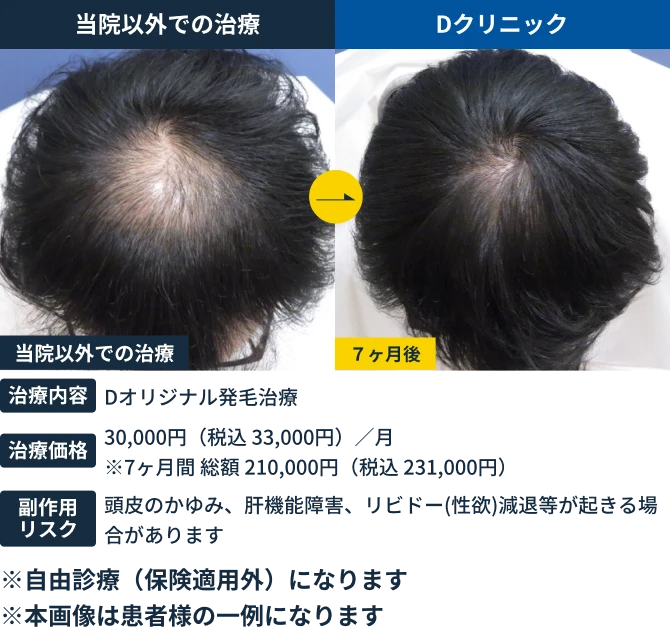 パーソナル発毛治療