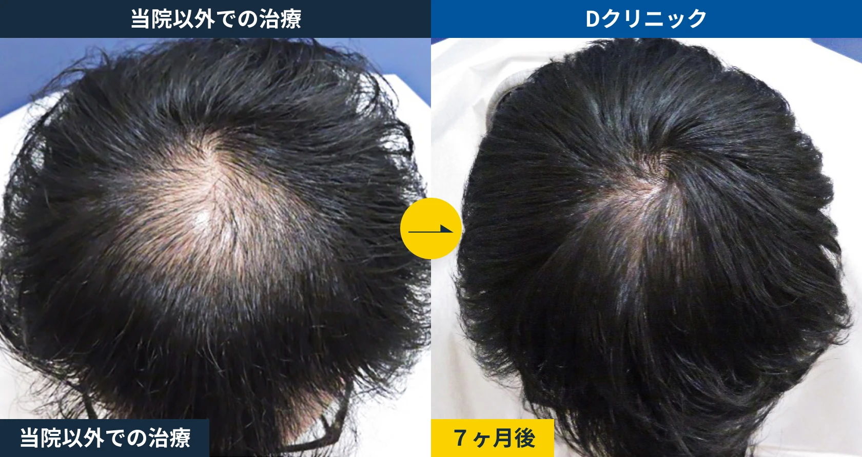 他院AGA治療からの乗り換え(30代)