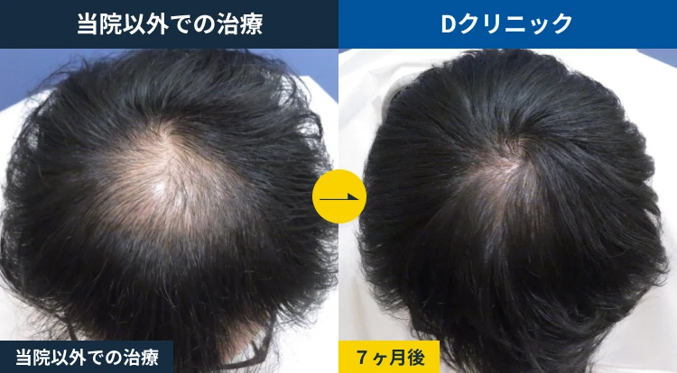 他院AGA治療からの乗り換え(30代)