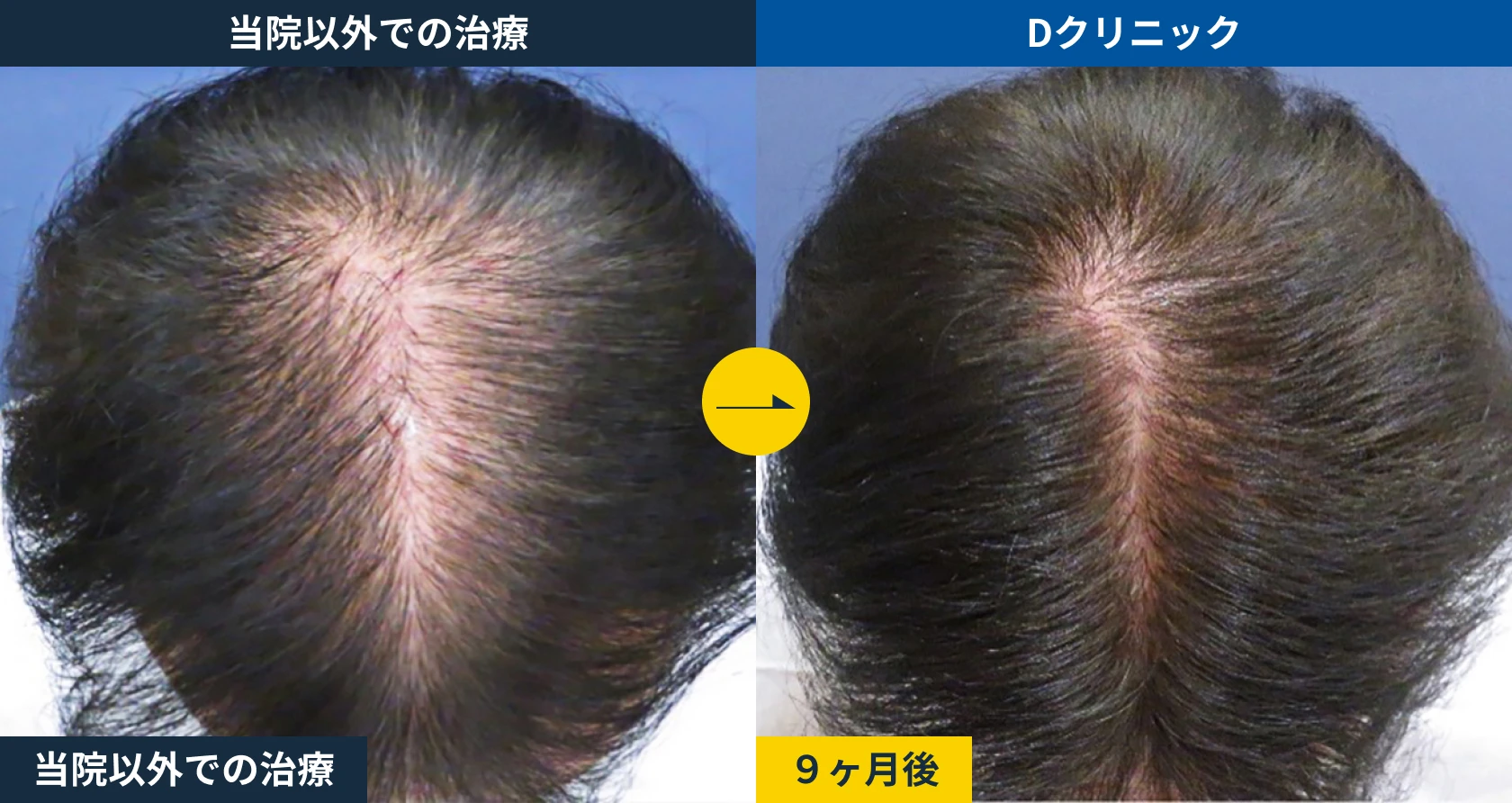 市販発毛剤からの乗り換え(50代)