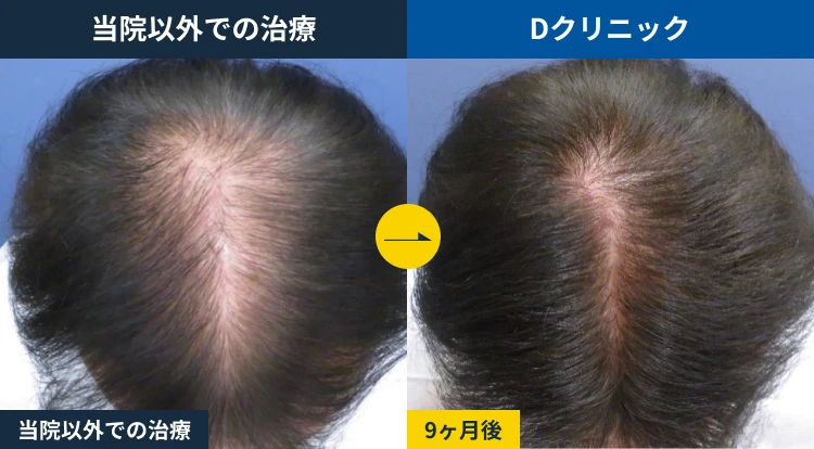 市販発毛剤からの乗り換え(50代)