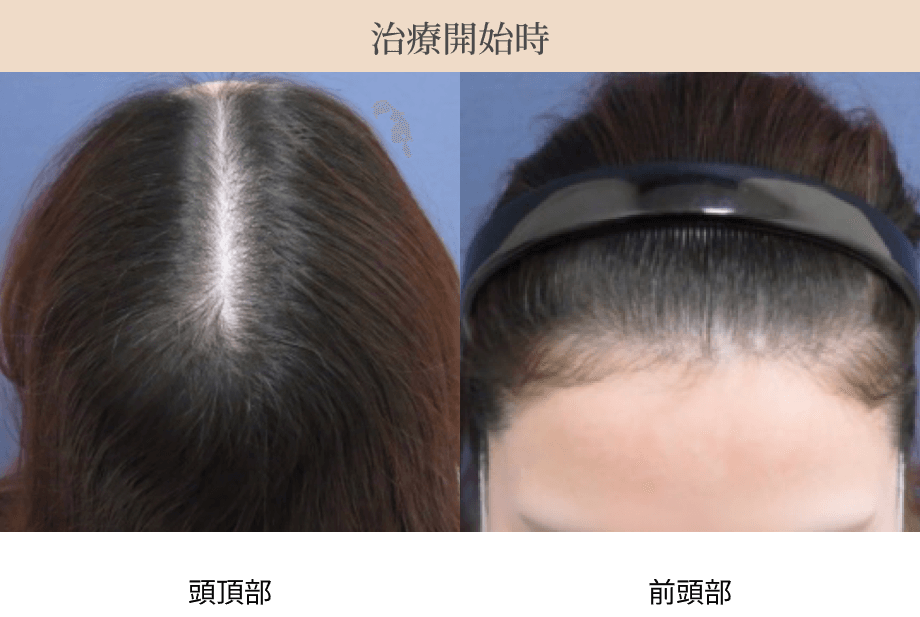 治療開始時の頭頂部・前頭部の画像
