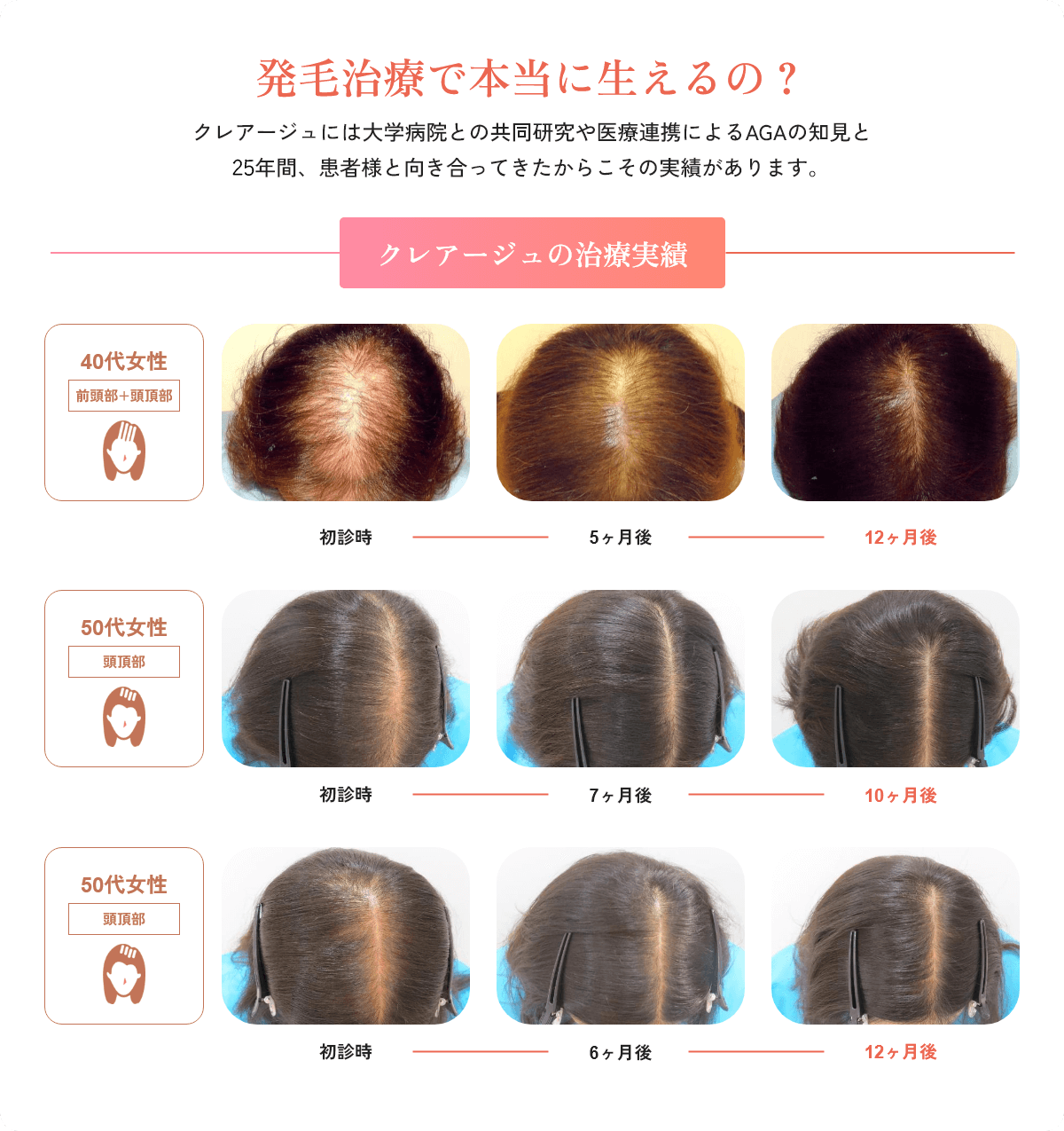 発毛治療で本当に生えるの？クレアージュには大学病院との共同研究や医療連携によるAGAの知見と25年間、患者様と向き合ってきたからこその実績があります。クレアージュの治療実績画像